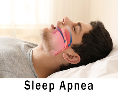 Image of Sleep Apnea