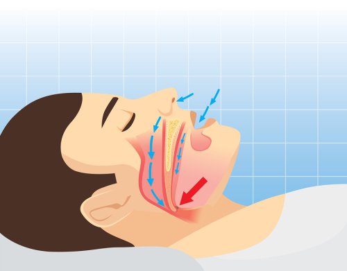 What Causes Snoring? | Smiles @ Southcenter