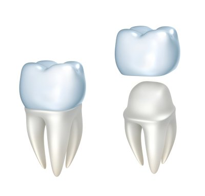 Image of a dental crown