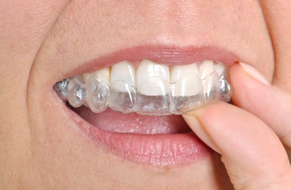 Woman placing invisalign