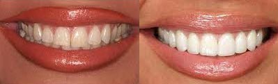 Veneers Before and After