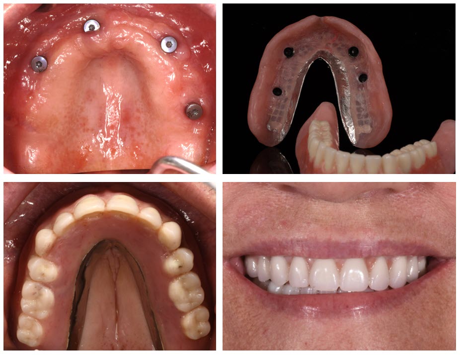 implant dentures tukwila